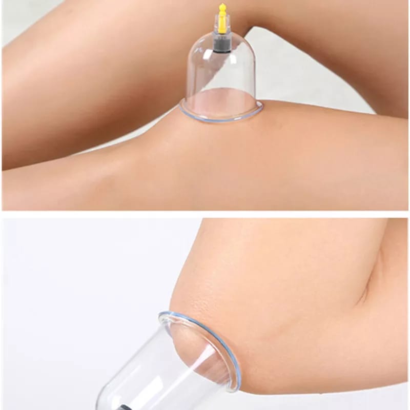 Vacuum Cupping Therapy Set is Plcaed On the  Body Of a Person