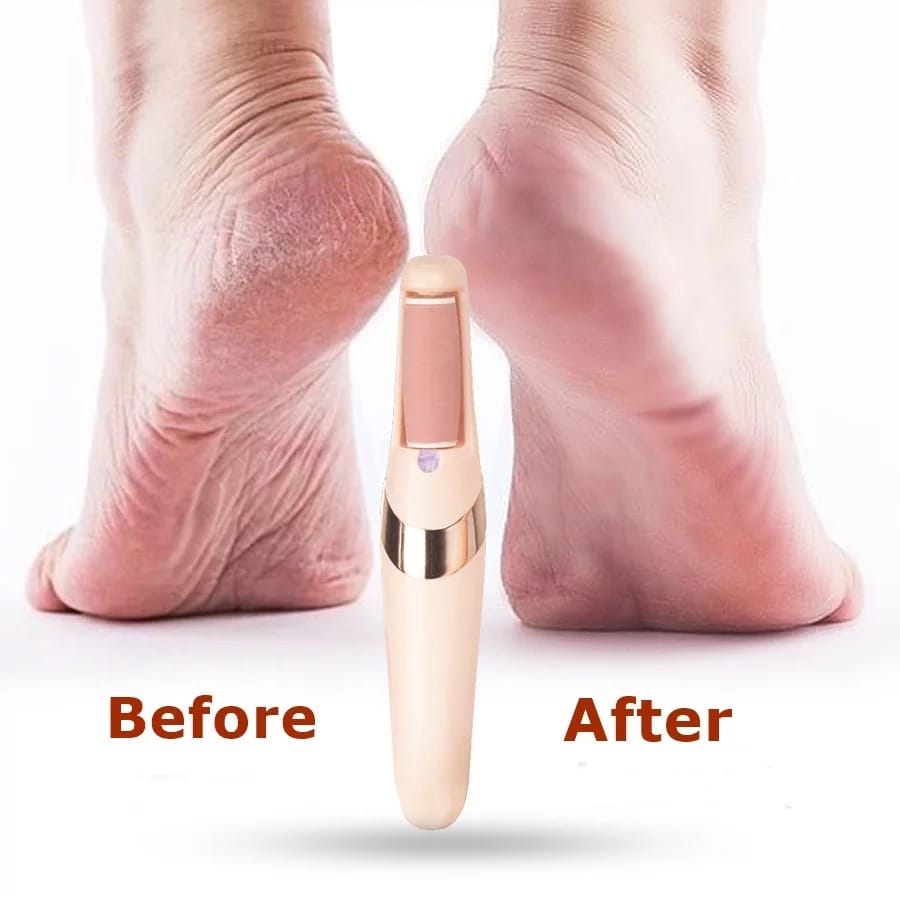  An image displaying a woman's feet, highlighting the visible difference achieved through a foot pedicure using a Portable Electric Pedicure Foot Callus Remover